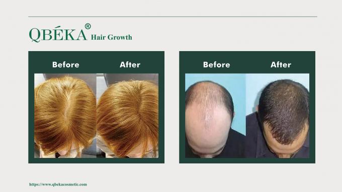 Shampoo estándar de prevención de la pérdida de cabello para el tratamiento de la pérdida y adelgazamiento del cabello 80m 10