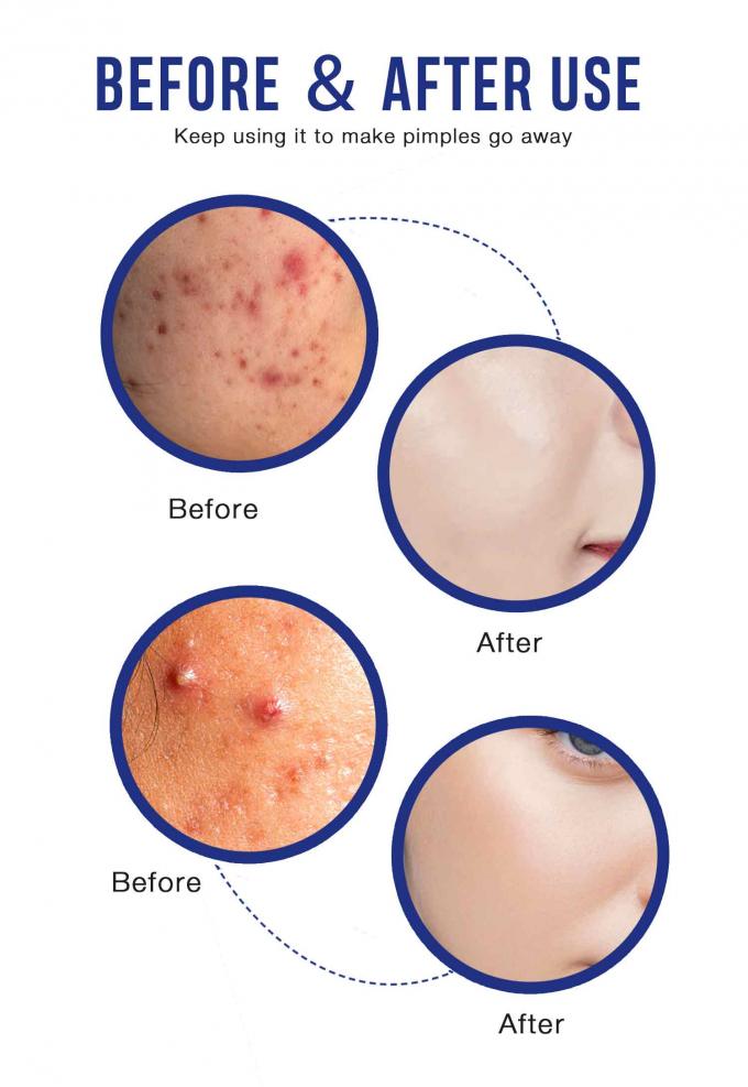 Cremas naturales para el tratamiento del acné cantidad 1000 9