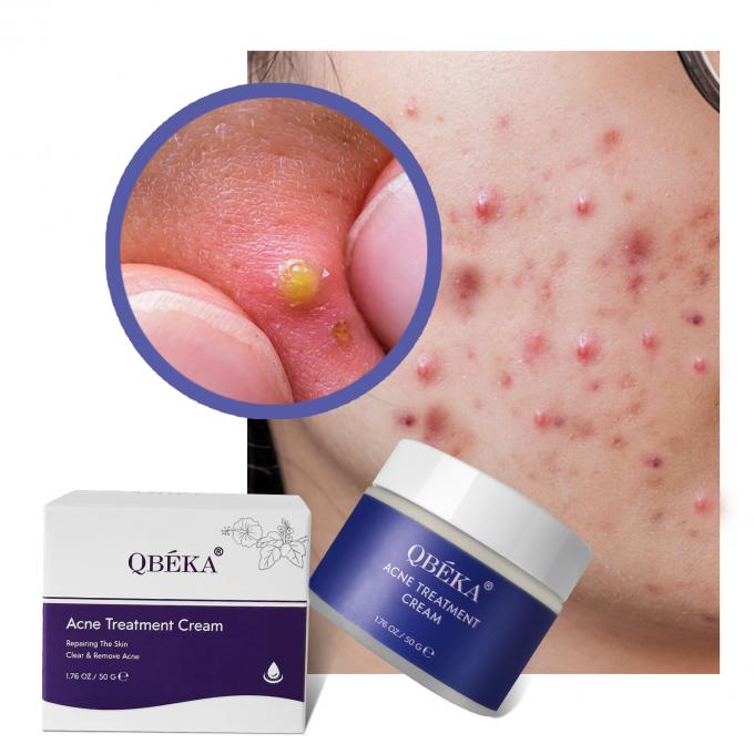 Efectiva crema para el tratamiento del acné con té verde para mujeres a granel 1